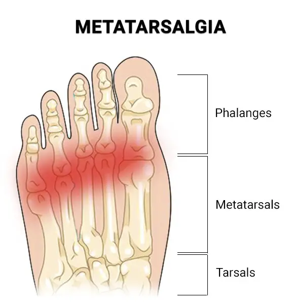 How to Place Metatarsal Pads