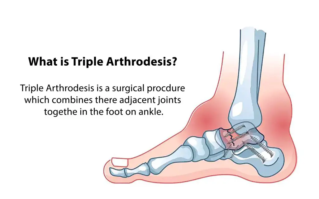 Best Shoes after Triple Arthrodesis