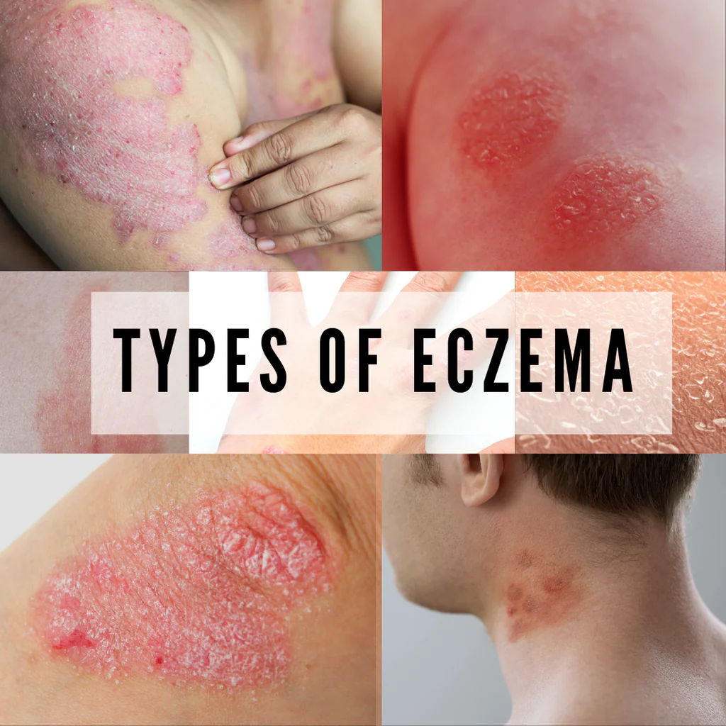 What Cream For Eczema